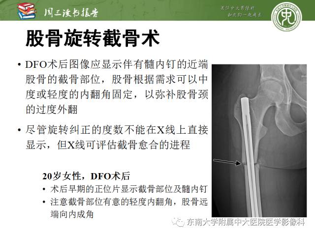 【PPT】髋关节保留术术后影像学表现