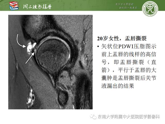 【PPT】髋关节保留术术后影像学表现