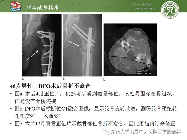 【PPT】髋关节保留术术后影像学表现