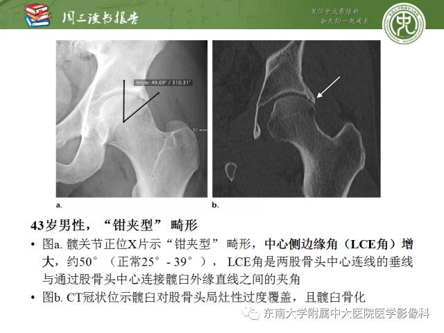【PPT】髋关节保留术术后影像学表现