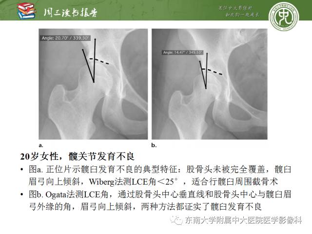 【PPT】髋关节保留术术后影像学表现