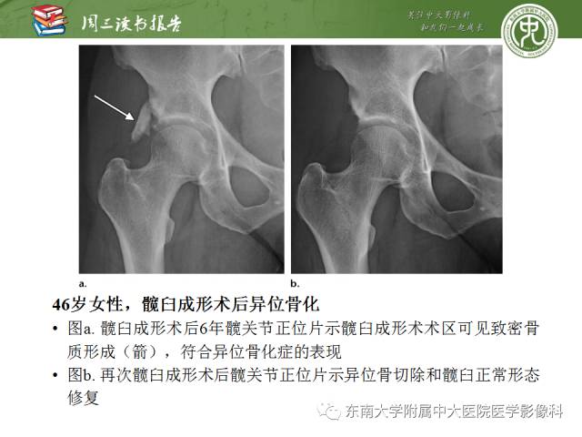 【PPT】髋关节保留术术后影像学表现