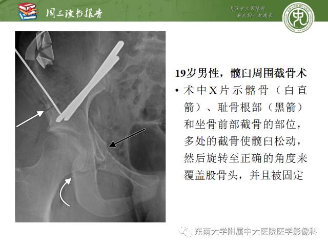 【PPT】髋关节保留术术后影像学表现