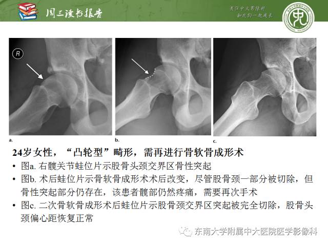 【PPT】髋关节保留术术后影像学表现