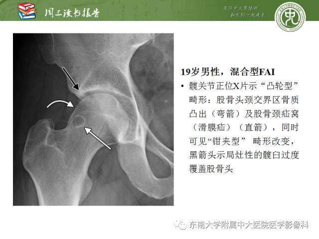 【PPT】髋关节保留术术后影像学表现