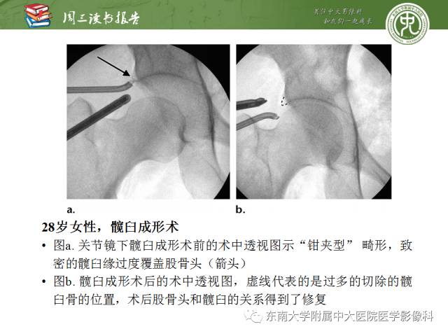 【PPT】髋关节保留术术后影像学表现