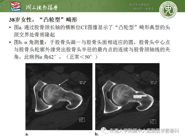 【PPT】髋关节保留术术后影像学表现
