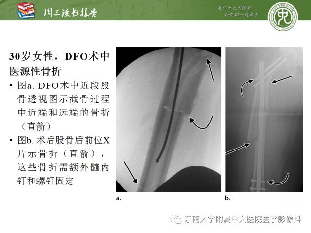 【PPT】髋关节保留术术后影像学表现