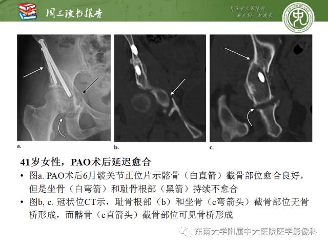 【PPT】髋关节保留术术后影像学表现