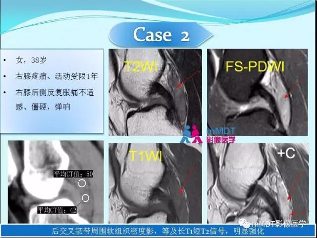 【PPT】膝关节色素沉着绒毛结节性滑膜炎影像表现PVNS