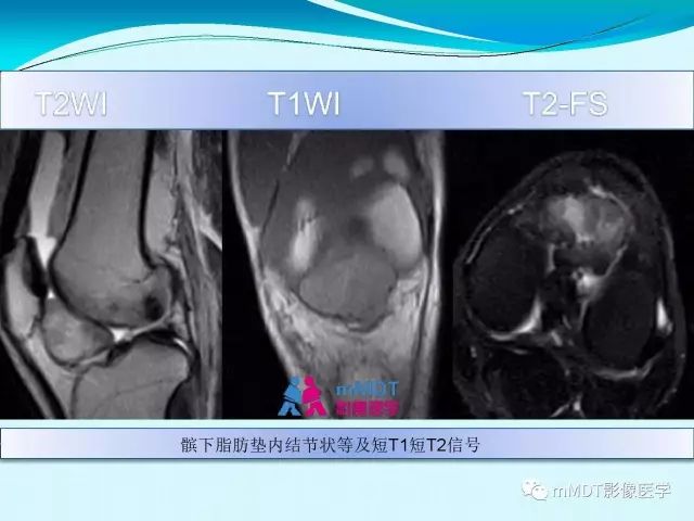【PPT】膝关节色素沉着绒毛结节性滑膜炎影像表现PVNS