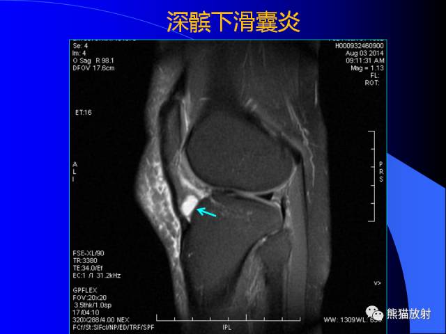 【PPT】膝关节周围囊肿MRI