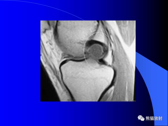 【PPT】膝关节周围囊肿MRI