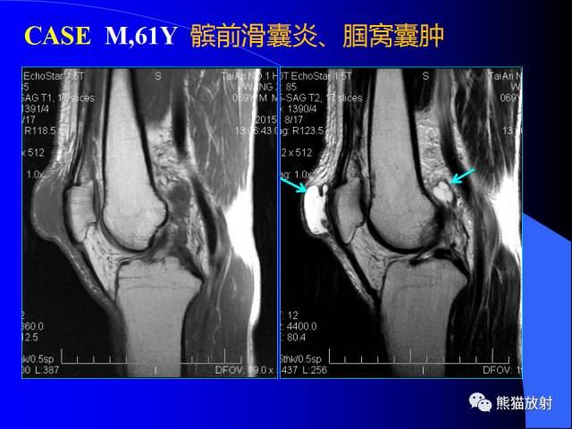 【PPT】膝关节周围囊肿MRI