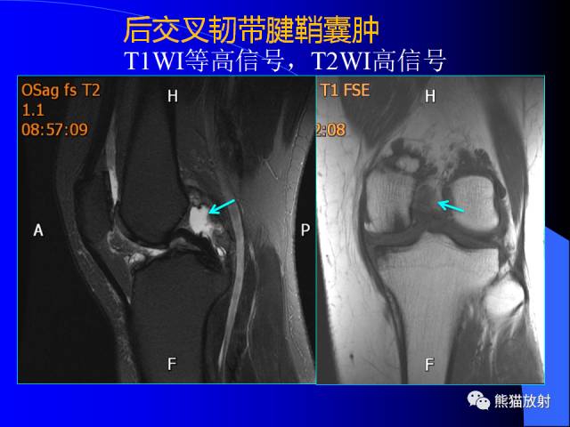 【PPT】膝关节周围囊肿MRI