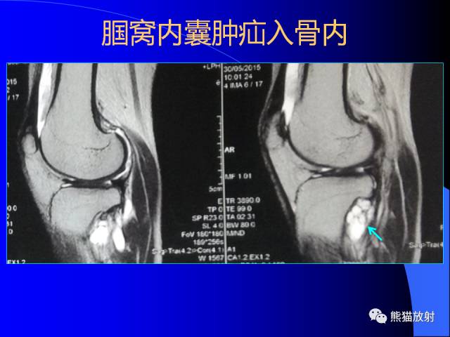 【PPT】膝关节周围囊肿MRI