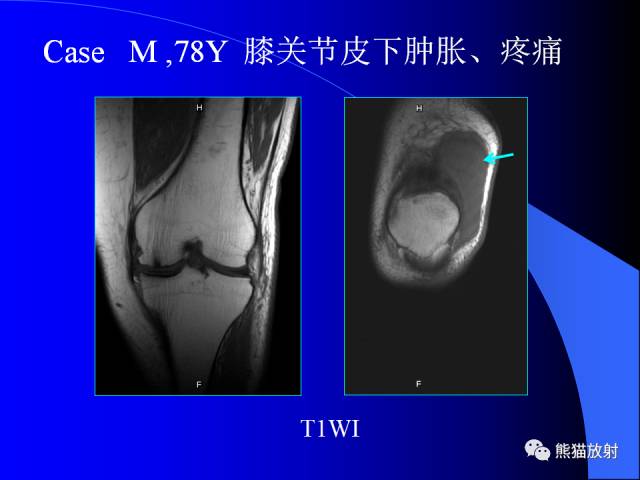 【PPT】膝关节周围囊肿MRI