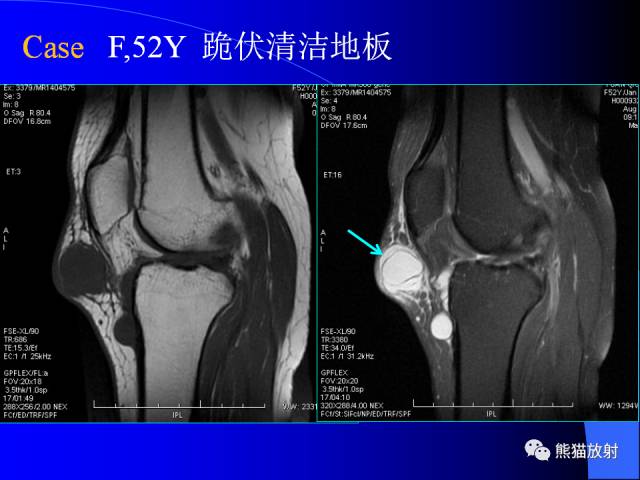 【PPT】膝关节周围囊肿MRI