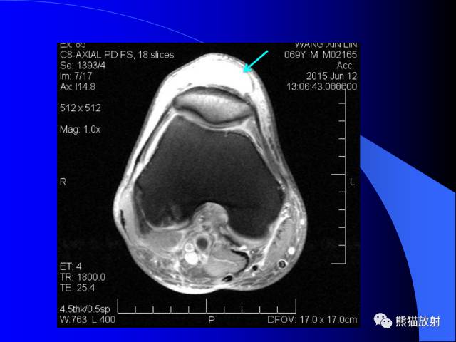 【PPT】膝关节周围囊肿MRI