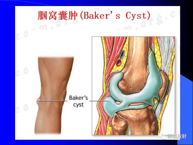 【PPT】膝关节周围囊肿MRI