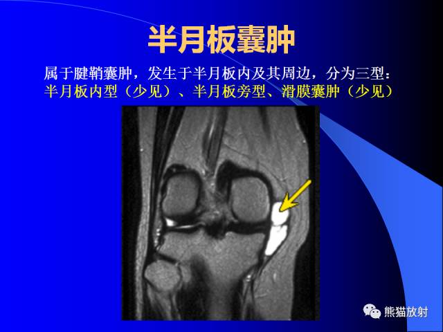 【PPT】膝关节周围囊肿MRI