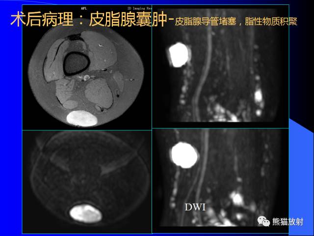【PPT】膝关节周围囊肿MRI