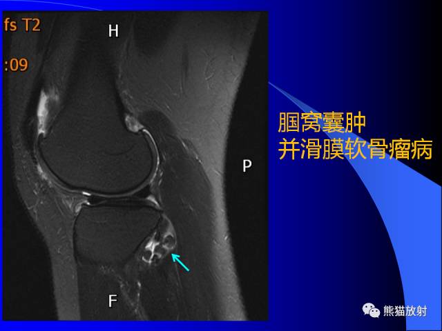 【PPT】膝关节周围囊肿MRI