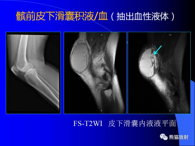 【PPT】膝关节周围囊肿MRI
