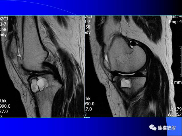 【PPT】膝关节周围囊肿MRI