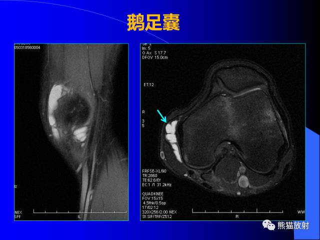 【PPT】膝关节周围囊肿MRI