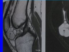 膝关节周围囊肿MRI