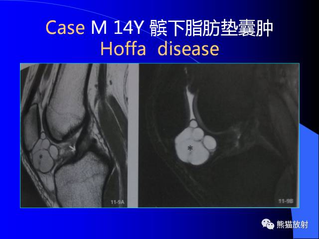 【PPT】膝关节周围囊肿MRI