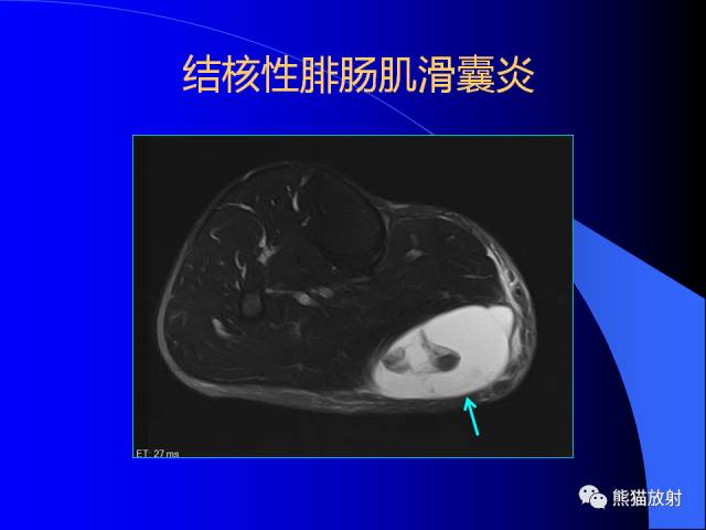 【PPT】膝关节周围囊肿MRI