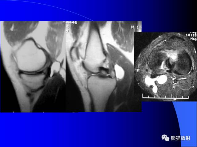 【PPT】膝关节周围囊肿MRI
