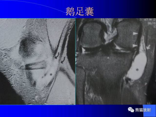 【PPT】膝关节周围囊肿MRI
