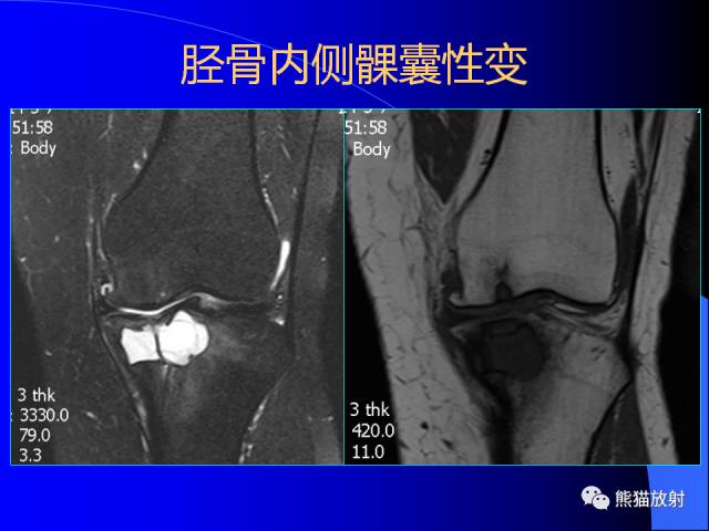 【PPT】膝关节周围囊肿MRI
