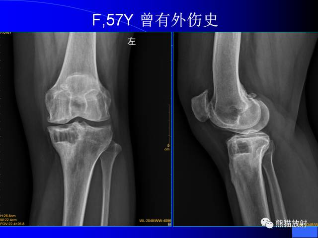 【PPT】膝关节周围囊肿MRI