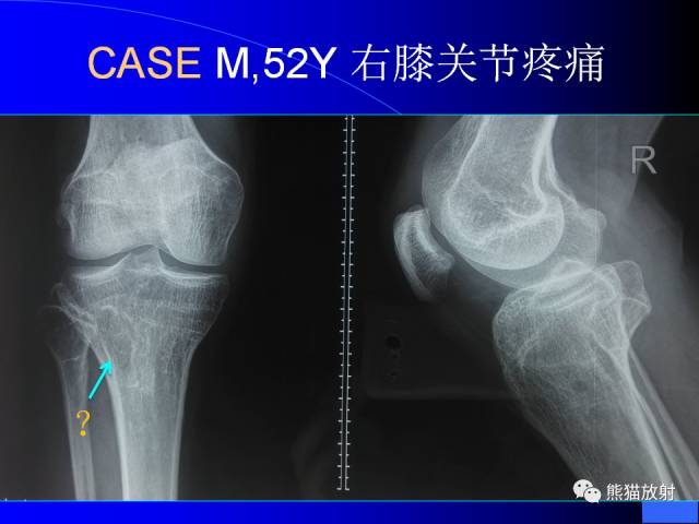 【PPT】膝关节周围囊肿MRI