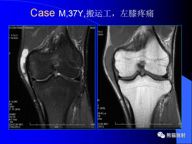 【PPT】膝关节周围囊肿MRI