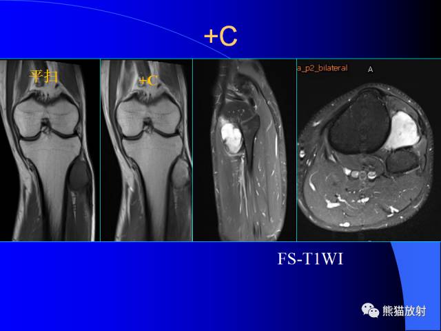 【PPT】膝关节周围囊肿MRI