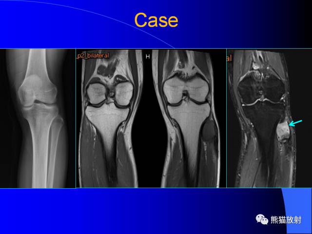 【PPT】膝关节周围囊肿MRI