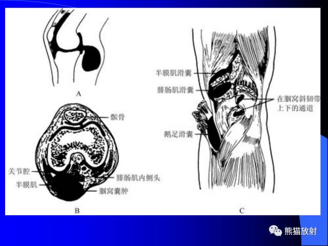 【PPT】膝关节周围囊肿MRI