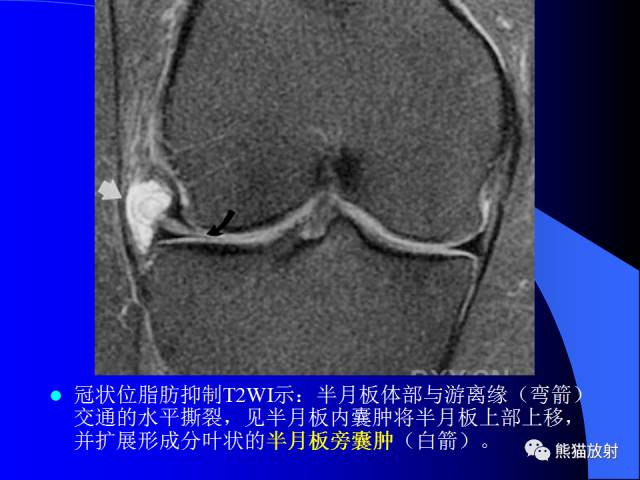 【PPT】膝关节周围囊肿MRI