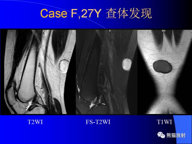 【PPT】膝关节周围囊肿MRI