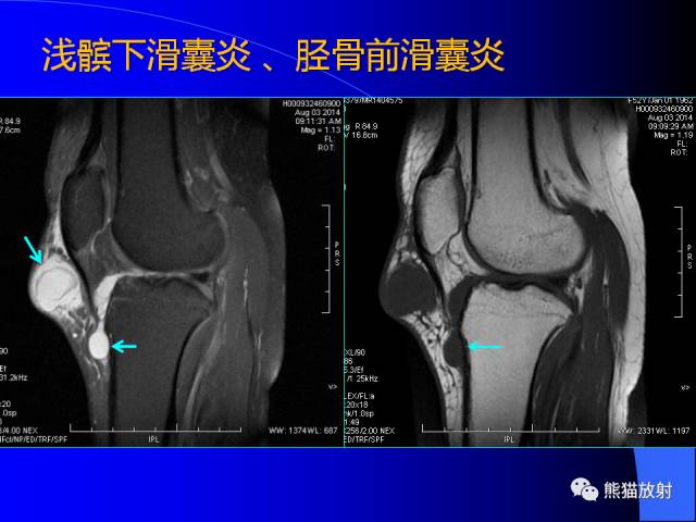 【PPT】膝关节周围囊肿MRI
