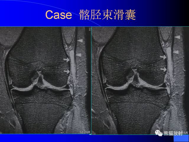 【PPT】膝关节周围囊肿MRI