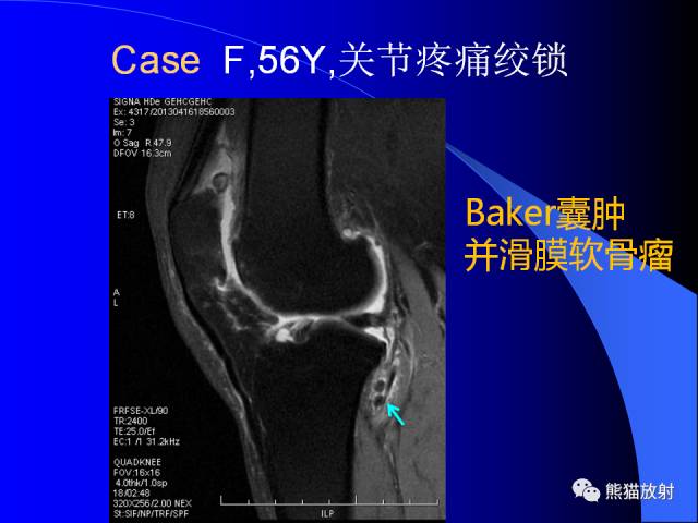 【PPT】膝关节周围囊肿MRI