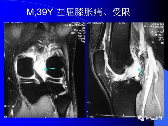 【PPT】膝关节周围囊肿MRI