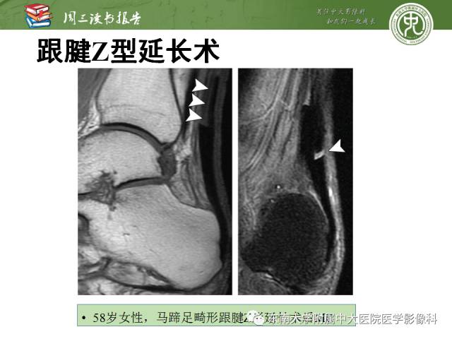 【PPT】踝及足术后CT和MR成像