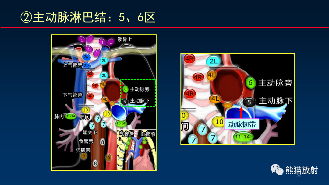 【PPT】纵隔与肺门淋巴结的识别与精准CT分区-32
